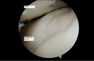 ขอ astroscope บนหัวข้องกับ osteoarthritis ของระดับที่ 3