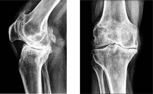 Gonarthrosis ของเข่าเมื่อเอ็กซ์เรย์