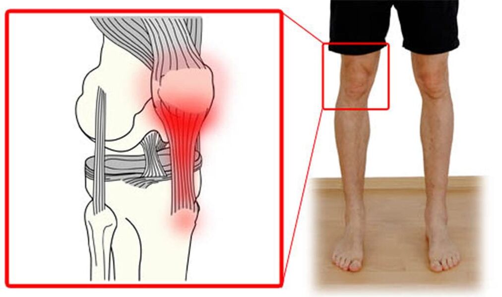 Tendinitis - การอักเสบของเส้นเอ็นในข้อเข่า