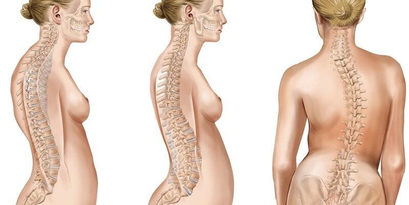 Scoliosis ของกระดูกสันหลังทรวงอกกระตุ้นความเจ็บปวดในหัวไหล่