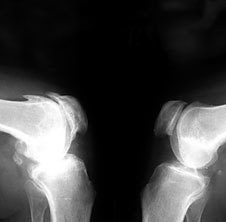 Osteoarthritis ในเอ็กซ์-เรย์