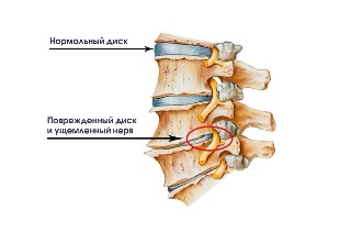 อาการของ cervical degenerative แผ่นเชื้อโรค