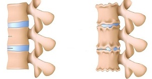 วิธีการรับรู้การปรากฏตัวของ osteochondrosis ของกระดูกสันหลังส่วนเอว