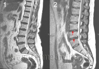 osteochondrosis ของกระดูกสันหลัง