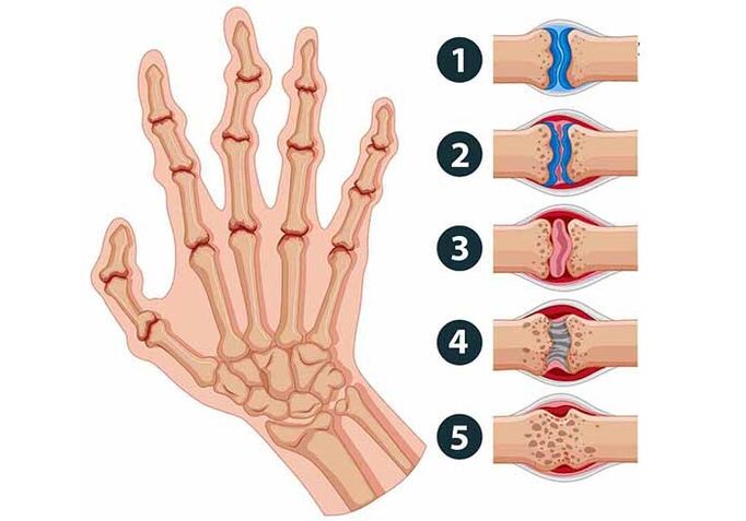 ขั้นตอนของการพัฒนาข้ออักเสบของข้อต่อของนิ้วมือ